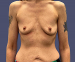 Breast Augmentation 19 Before